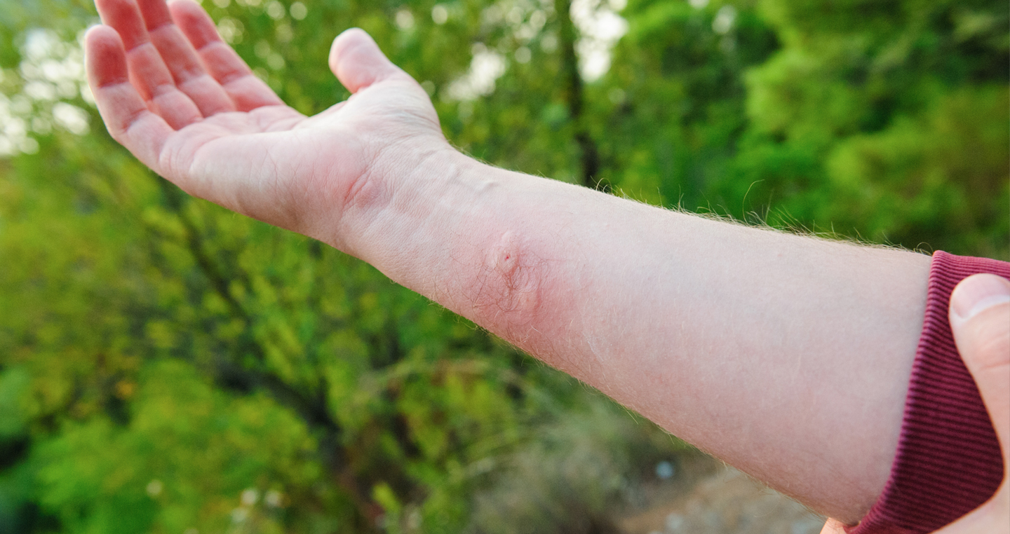 A fore arm with a noticeable bug bite. 