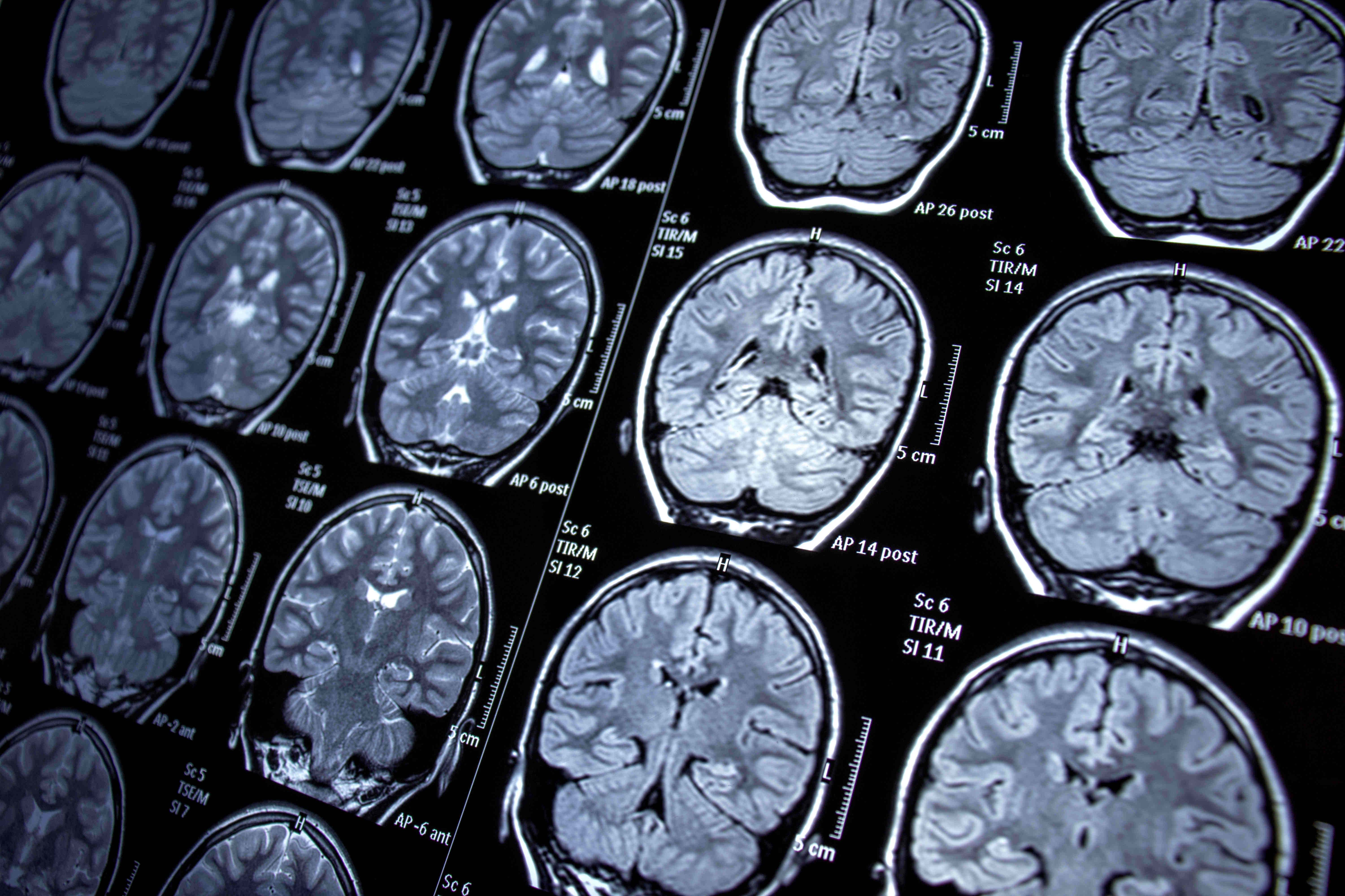 An imaging scan shows several images of a human brain.