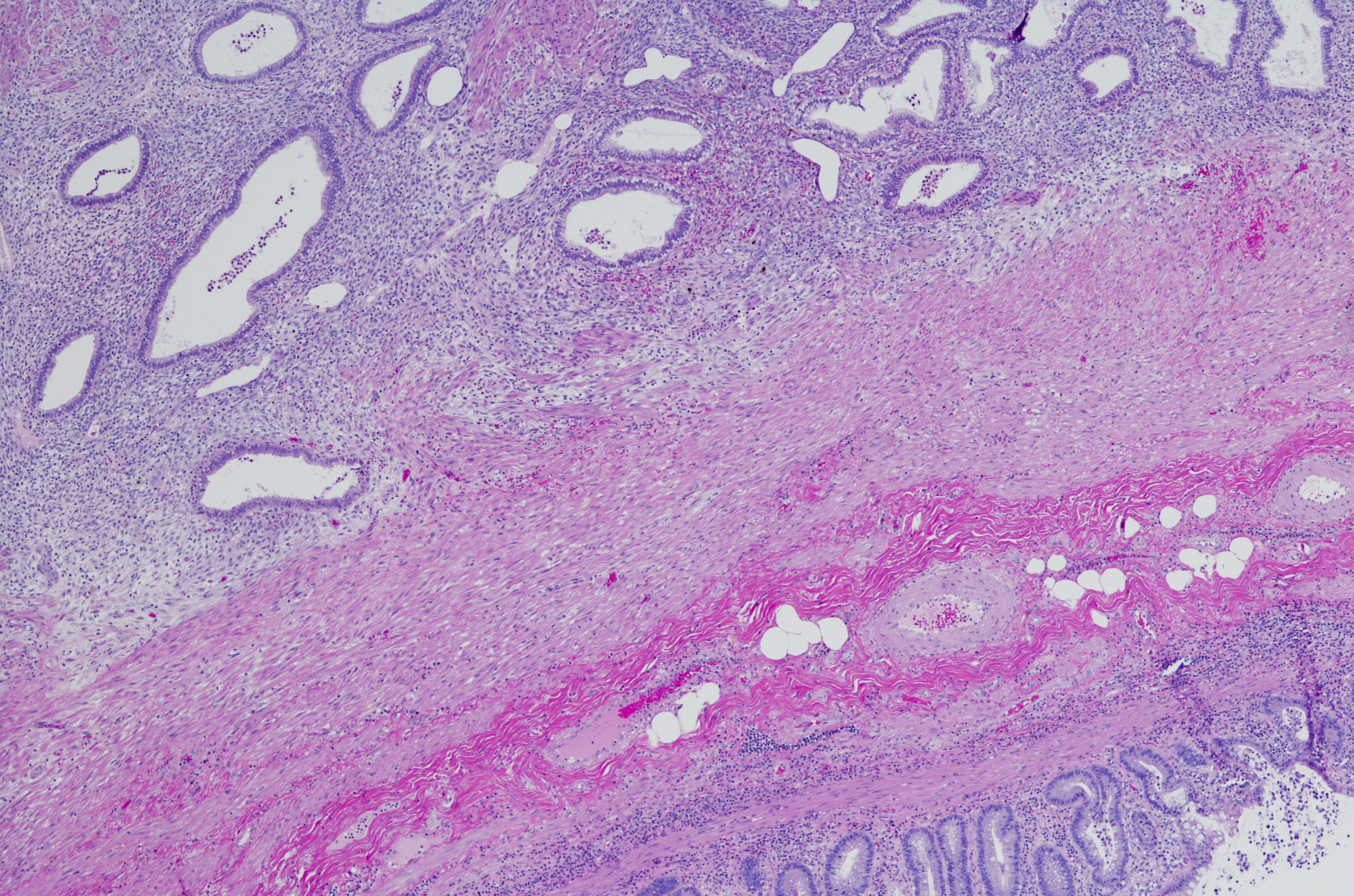 high magnification image of endometriosis in an appendix 