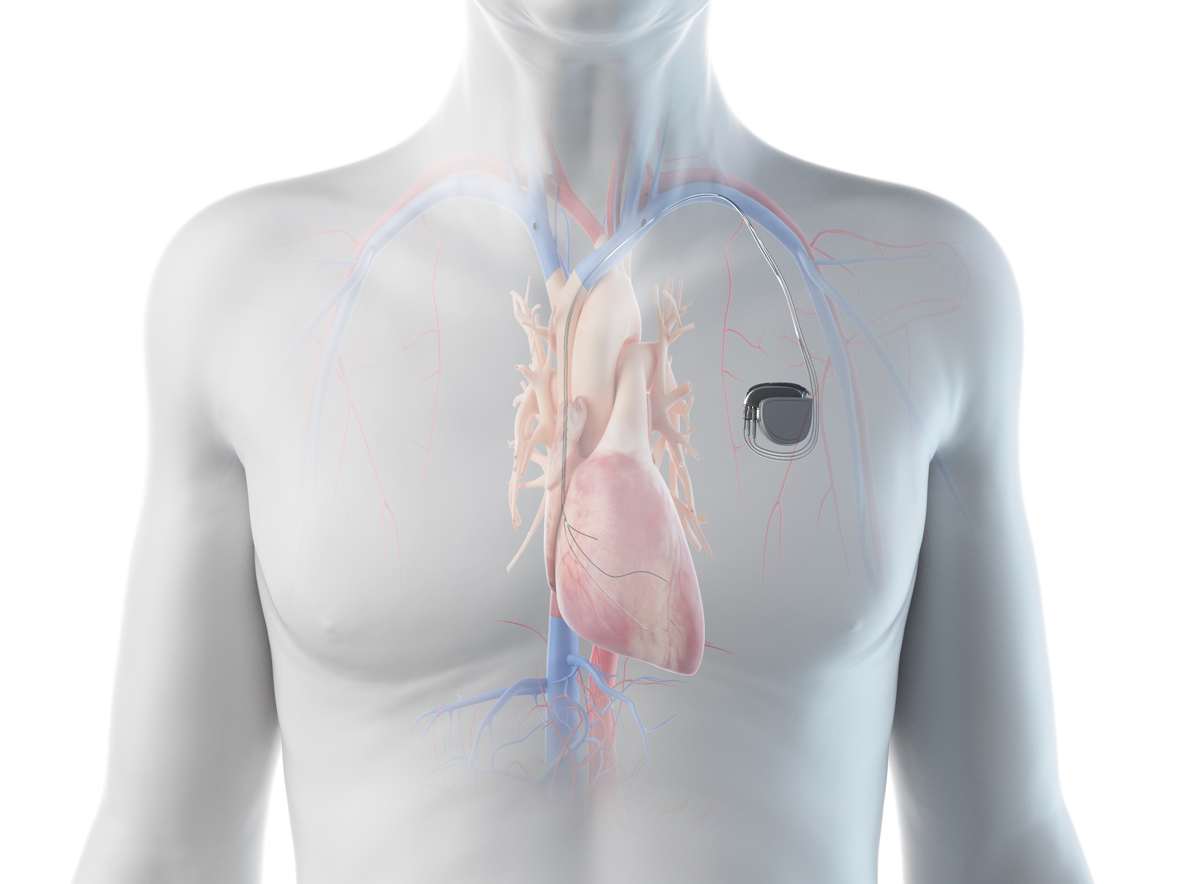 Chest of a person with a pacemaker