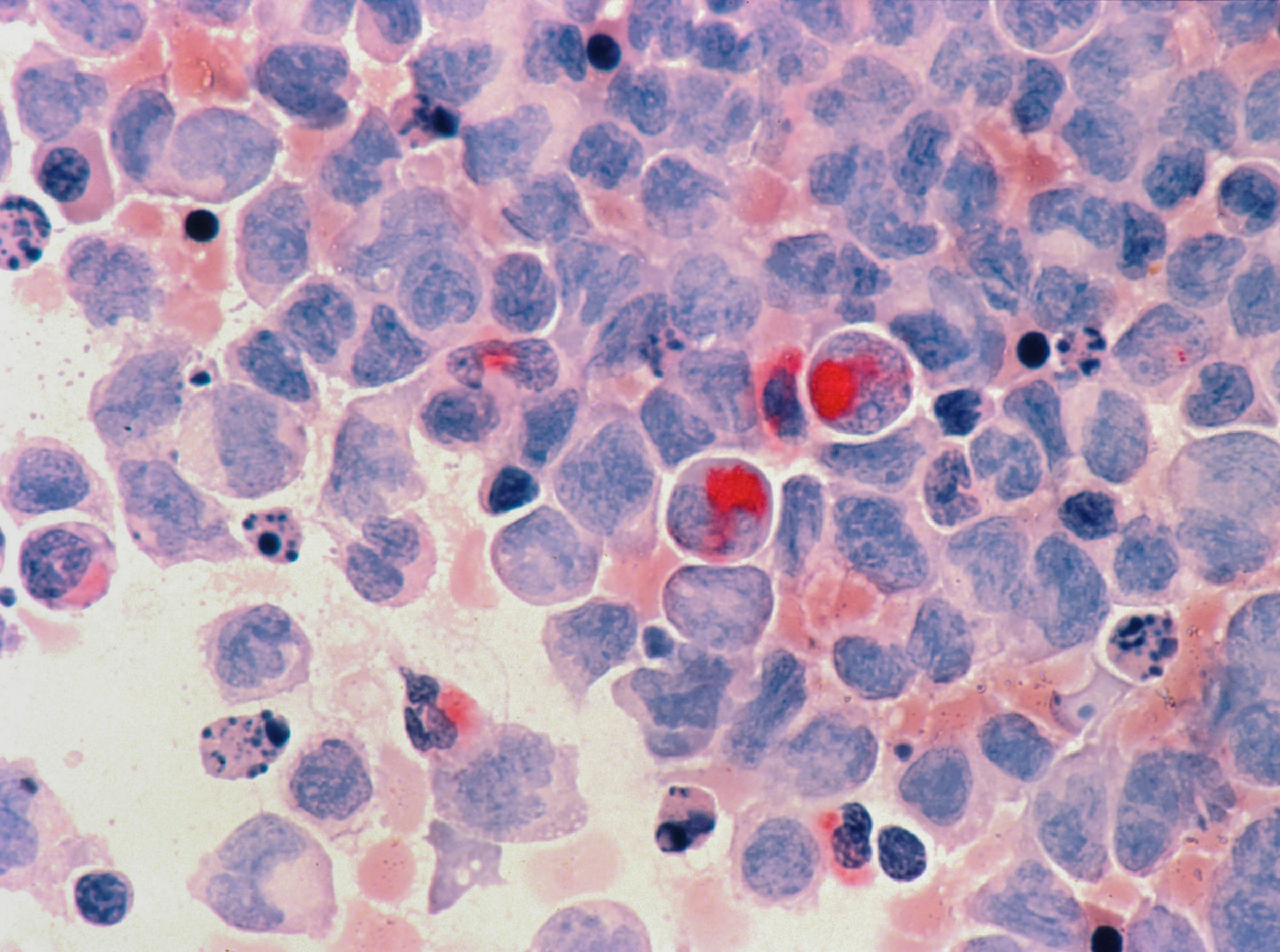 Acute myeloid leukemia cells