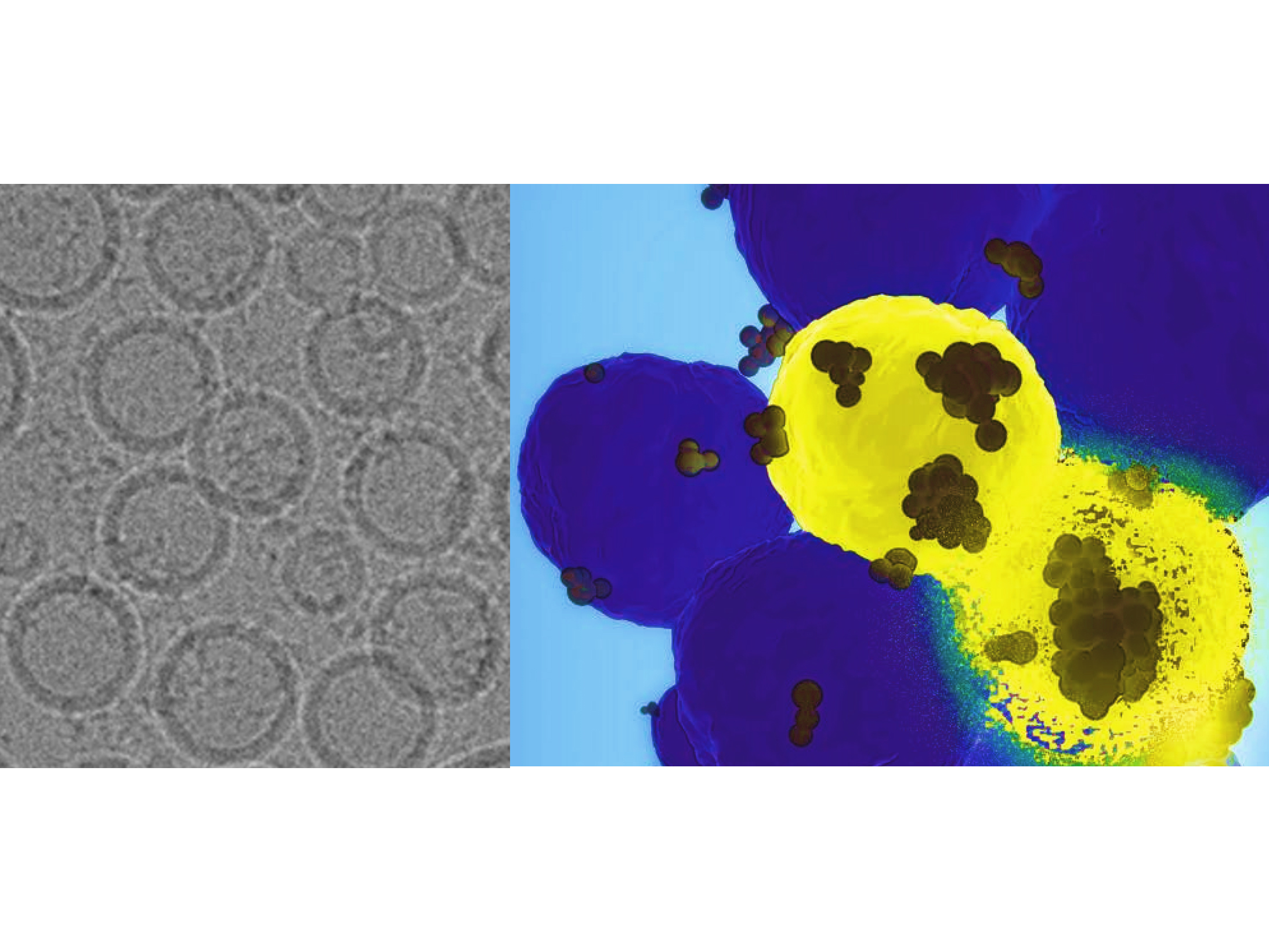 Gray-scale electron microscopic image of nanoparticles on left, blue and yellow image of cancer cells and nanoparticles on right