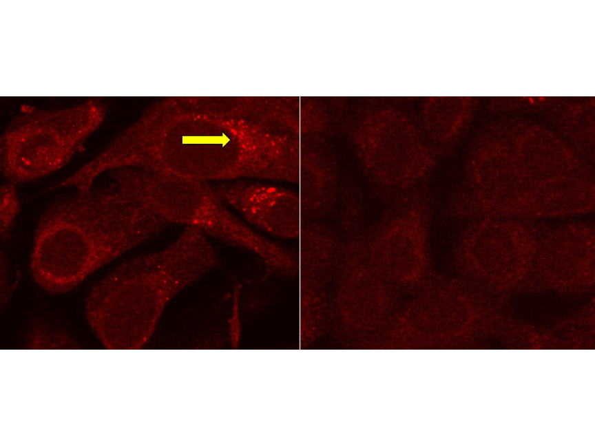 Non-cancerous and cancer cells stained for protein aggregates from cigarette smoke