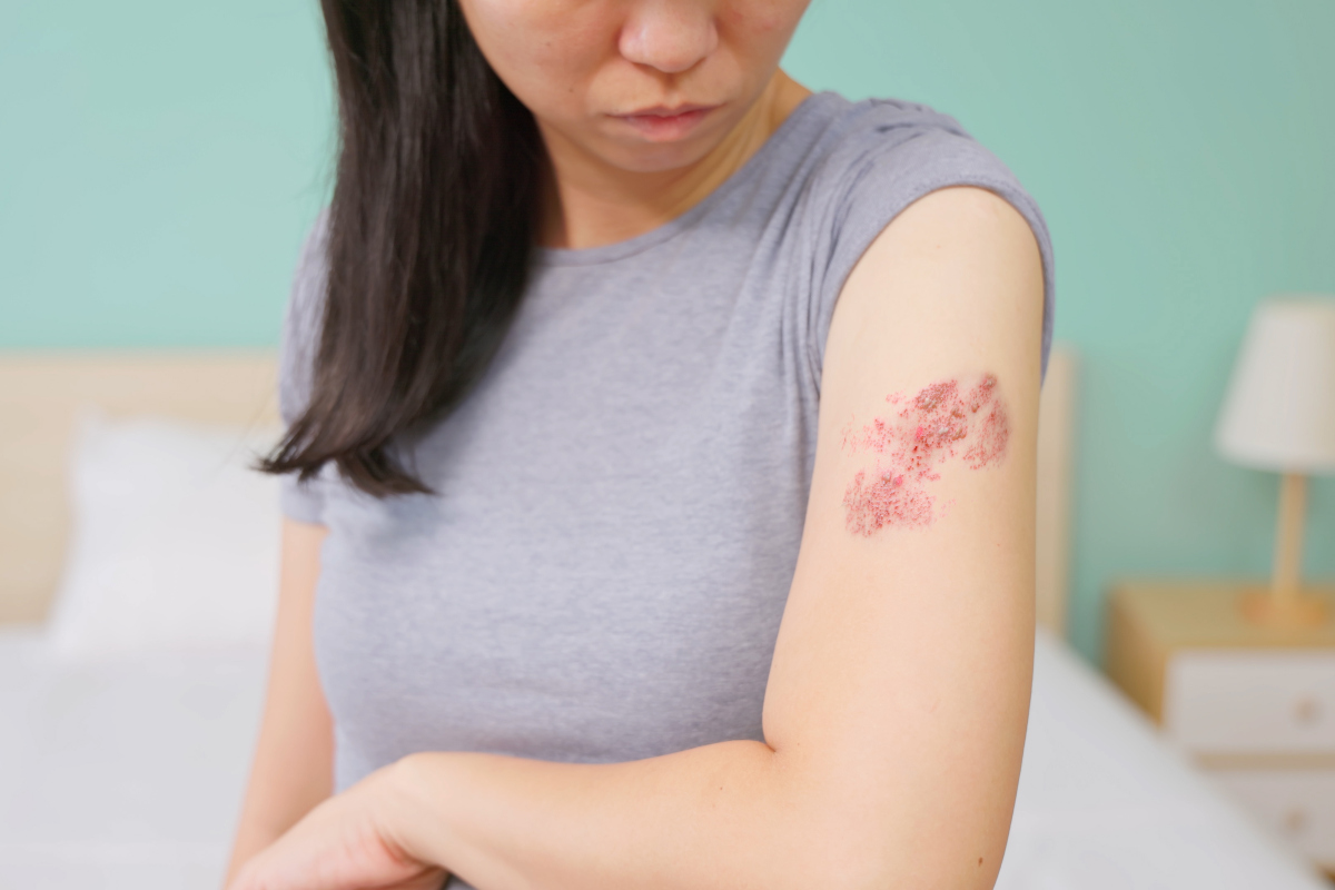 A young woman looks down at shingles rashes on her left arm. A bed and nightstand are in the background, slightly out of focus.