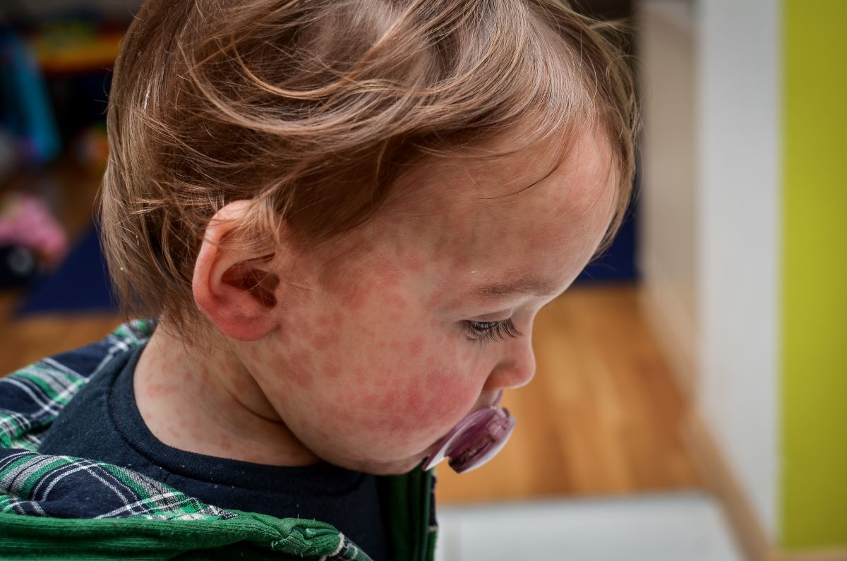 A toddler boy with a red measles rash on his face.