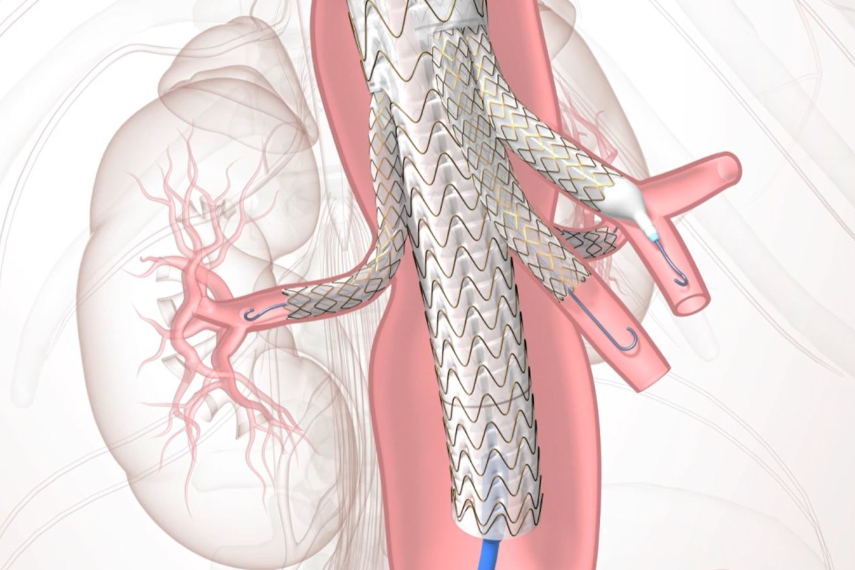 A graphic rendering of a TAMBE device – a stent graft with branches – in place within a patient’s blood vessels.