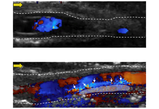 Two stacked ultrasound images. The top is dark with minimal spots of color, while the bottom is colorful with notable points of interest.