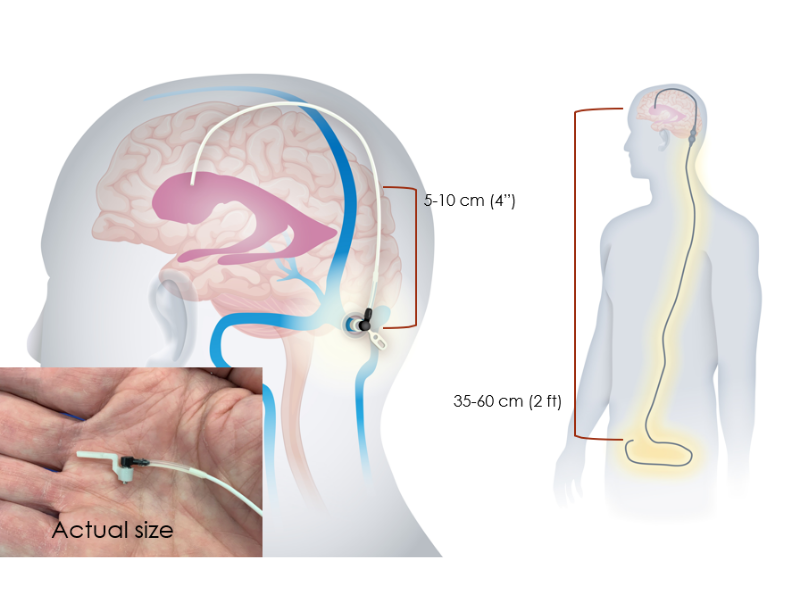 Cranial Devices, Inc. HydroFix shunt graphic, depicting the device's size and length in comparison to the spinal cord