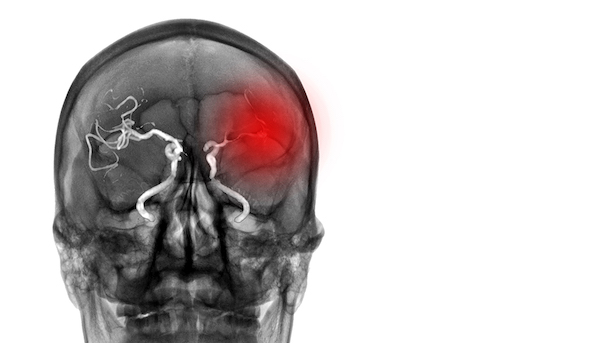 CT Scan of human head showing an absence of blood flow to left brain.