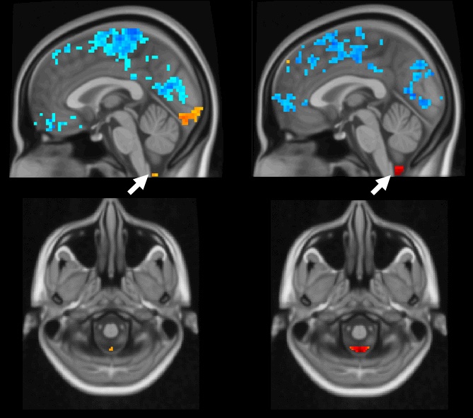 Side-by-side MRI images of a human brain in black and white with blue, orange and red pops of color. 