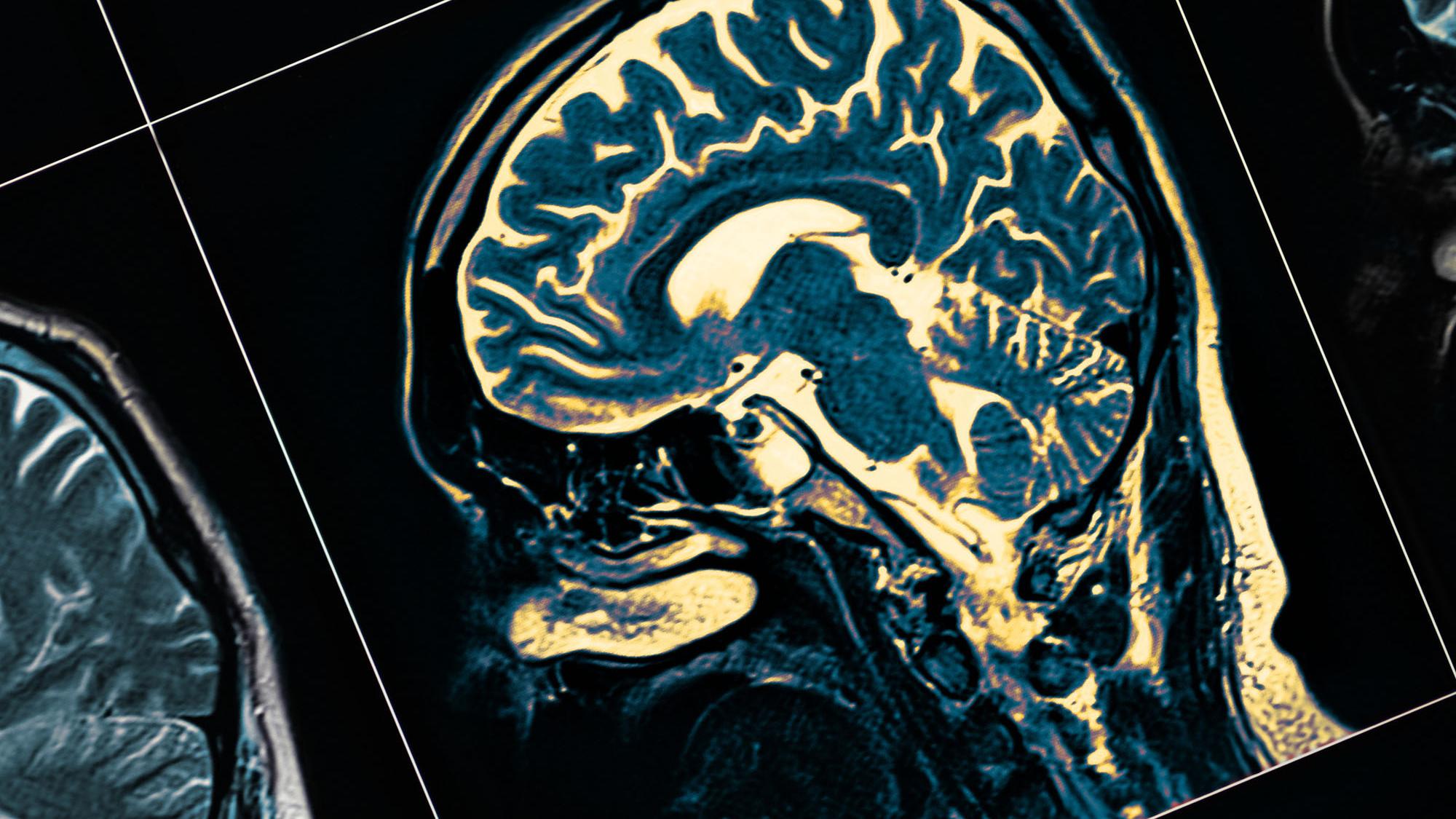 Photo of an MRI scan of the human brain.