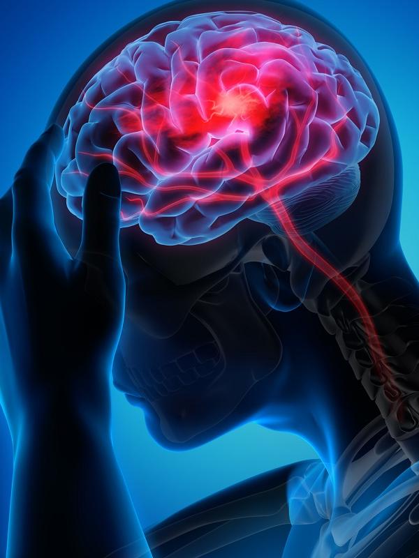 Medical illustration of a brain with stroke symptoms.