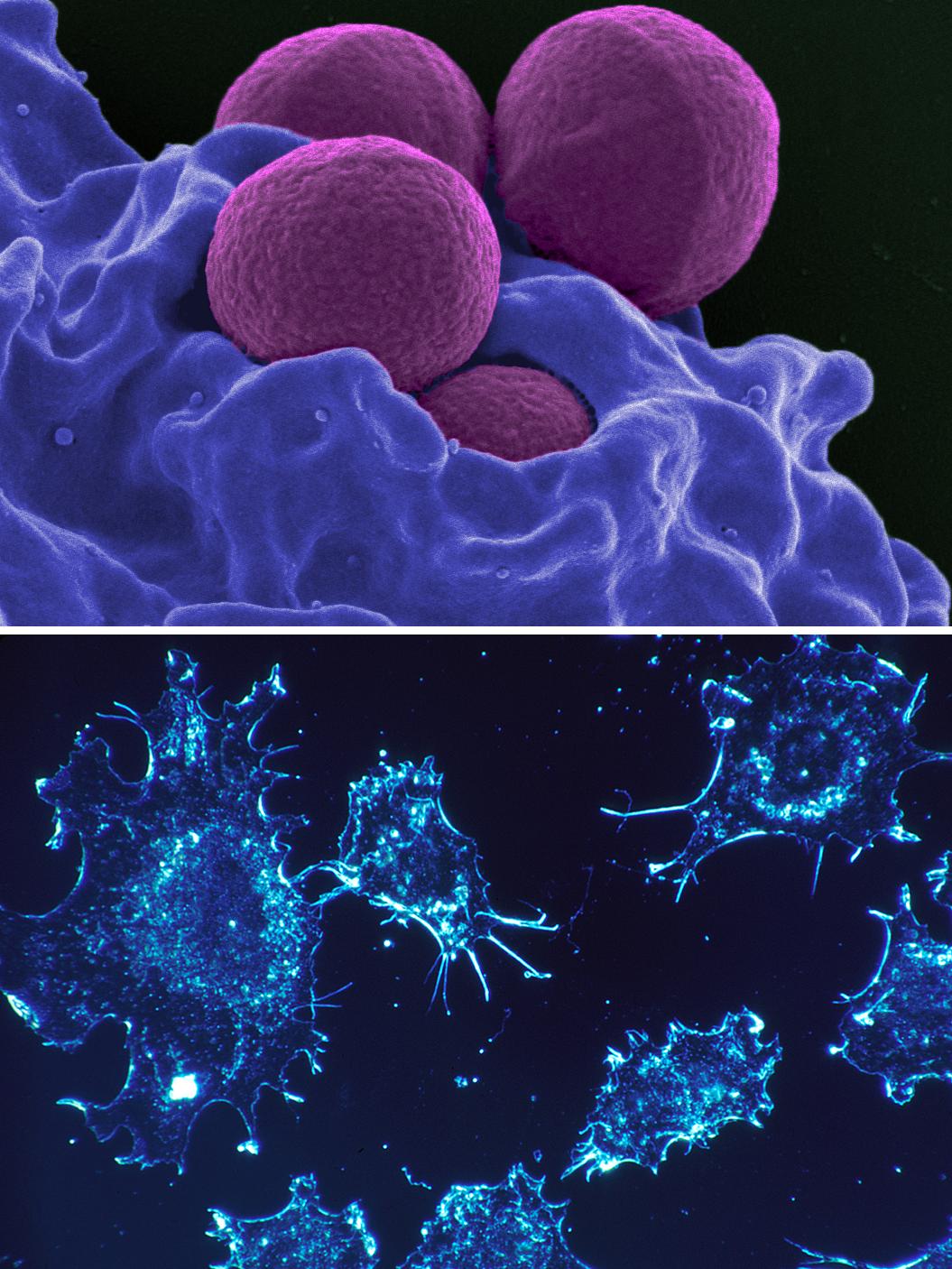 Two microscopic images: One of Staphylococcus aureus bacteria and the other of cancer cells