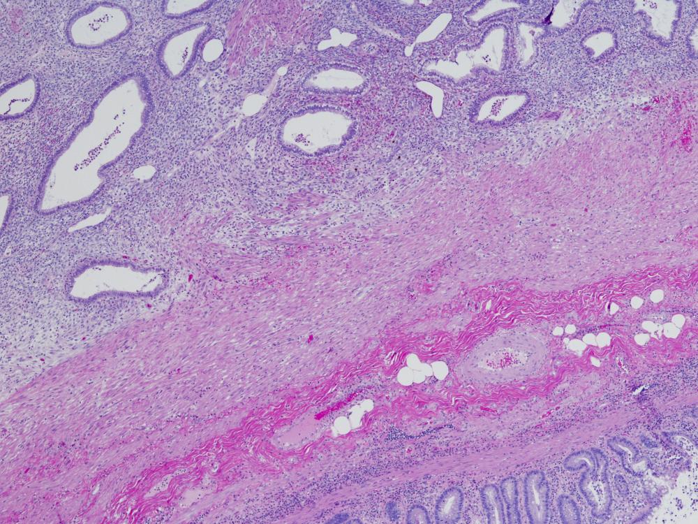 high magnification image of endometriosis in an appendix 