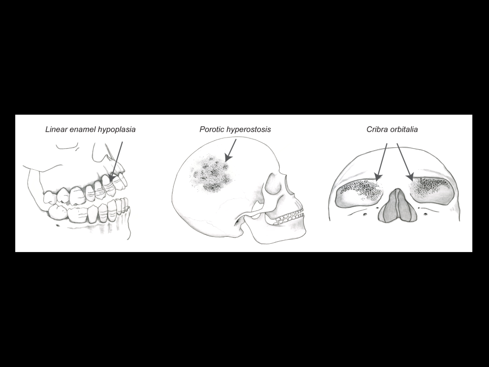image of lines on teeth, porosity on skull and on eye sockets