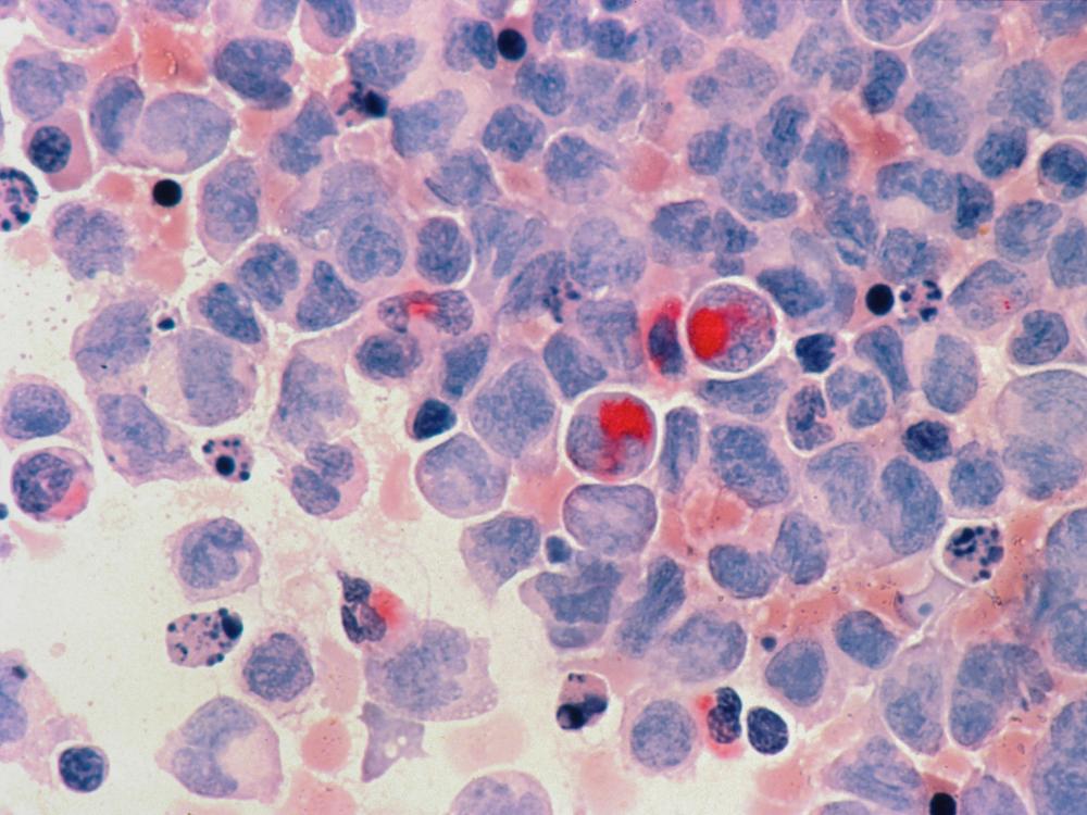 Acute myeloid leukemia cells