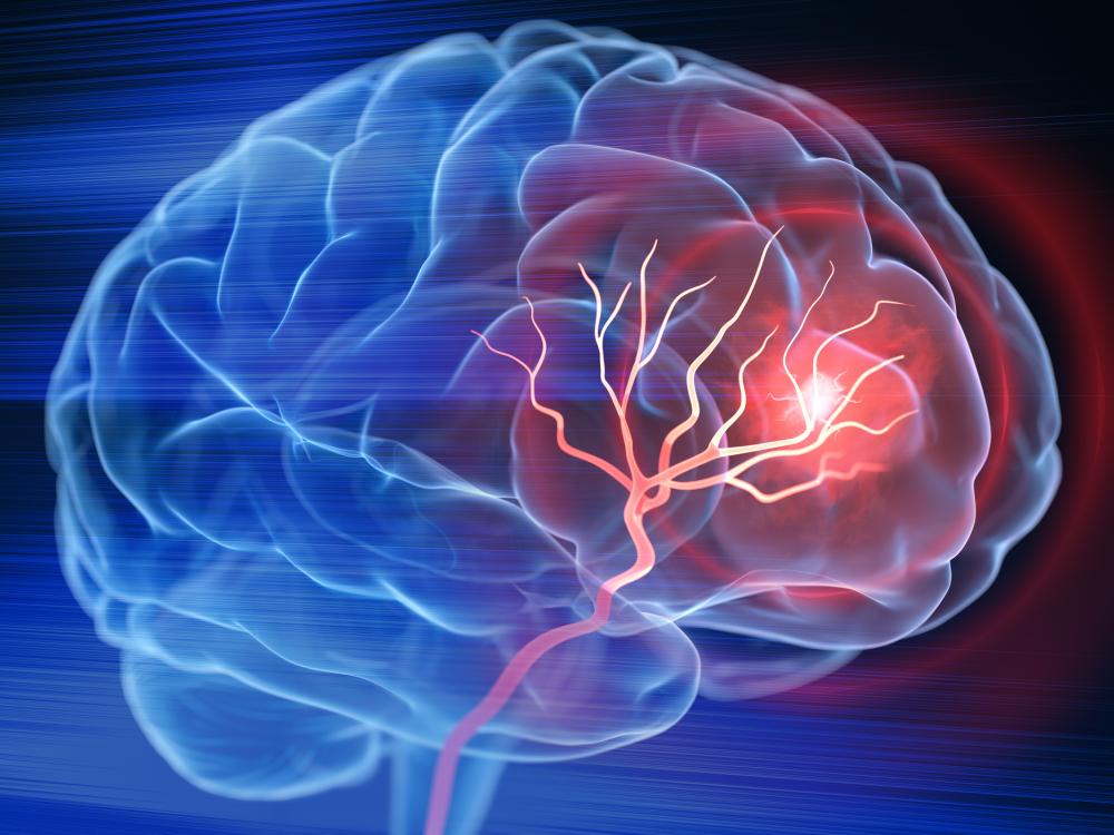 Illustration of a stroke in a brain