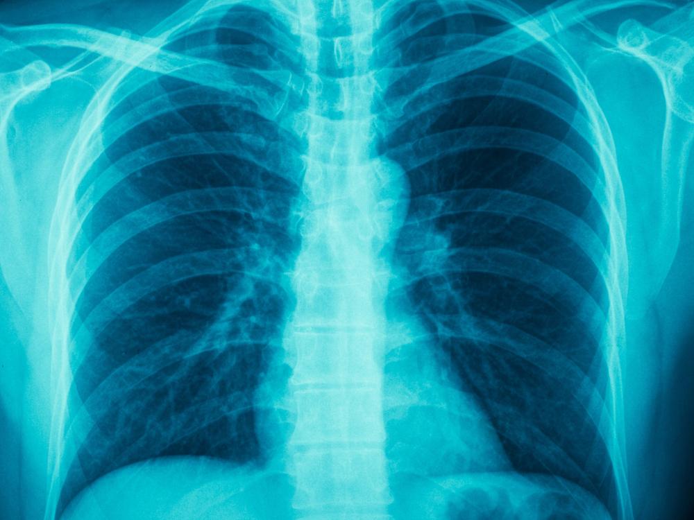 An X-ray of a chest.