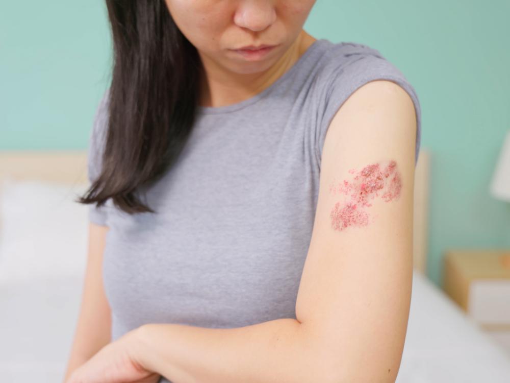 A young woman looks down at shingles rashes on her left arm. A bed and nightstand are in the background, slightly out of focus.