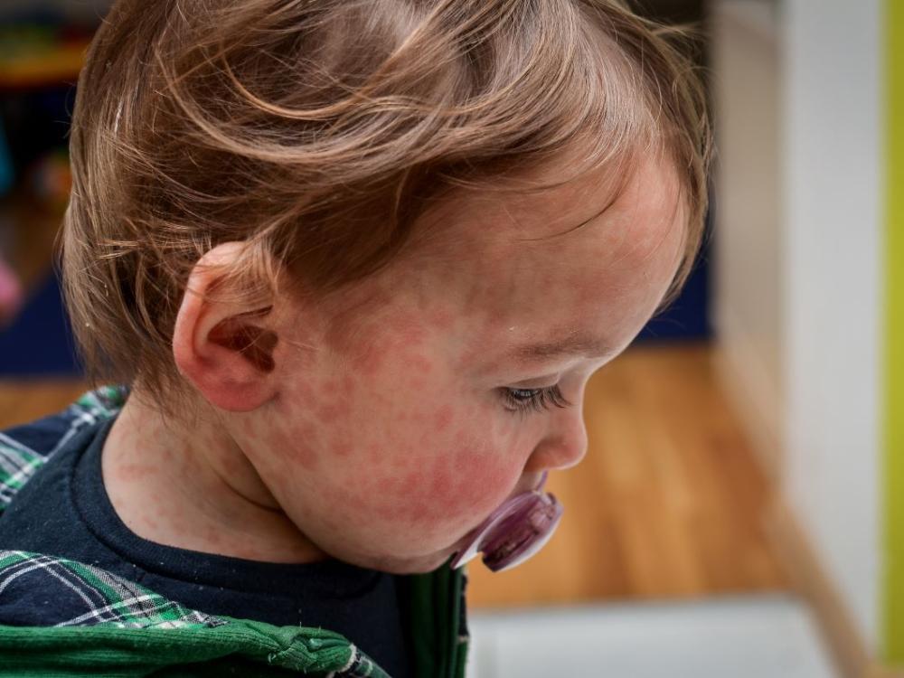 A toddler boy with a red measles rash on his face.