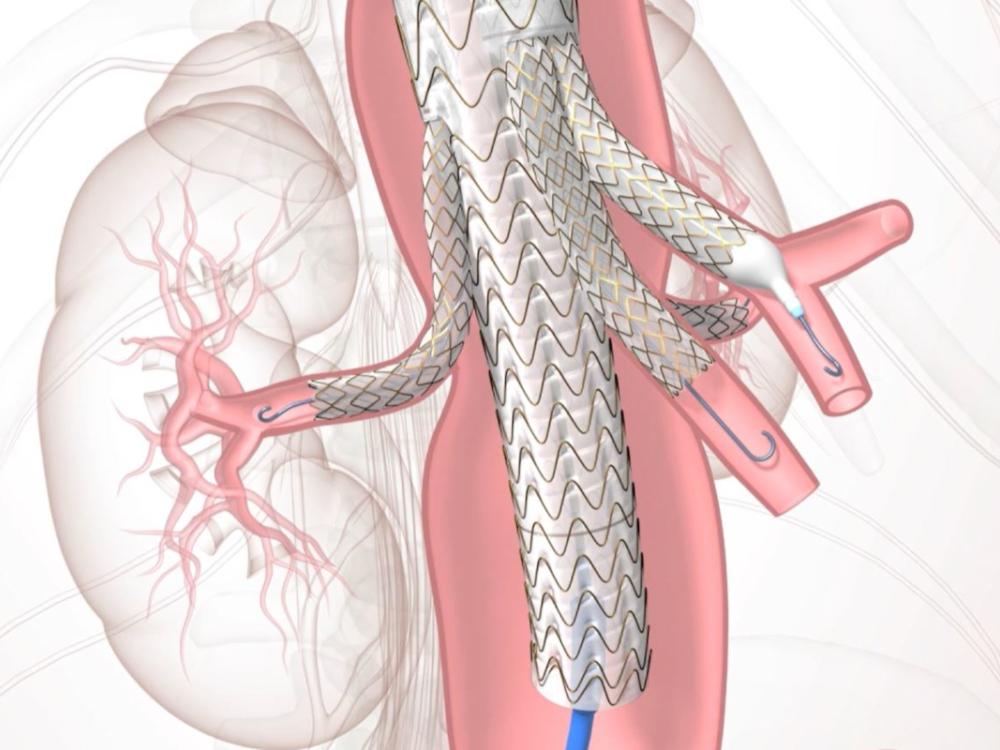 A graphic rendering of a TAMBE device – a stent graft with branches – in place within a patient’s blood vessels.