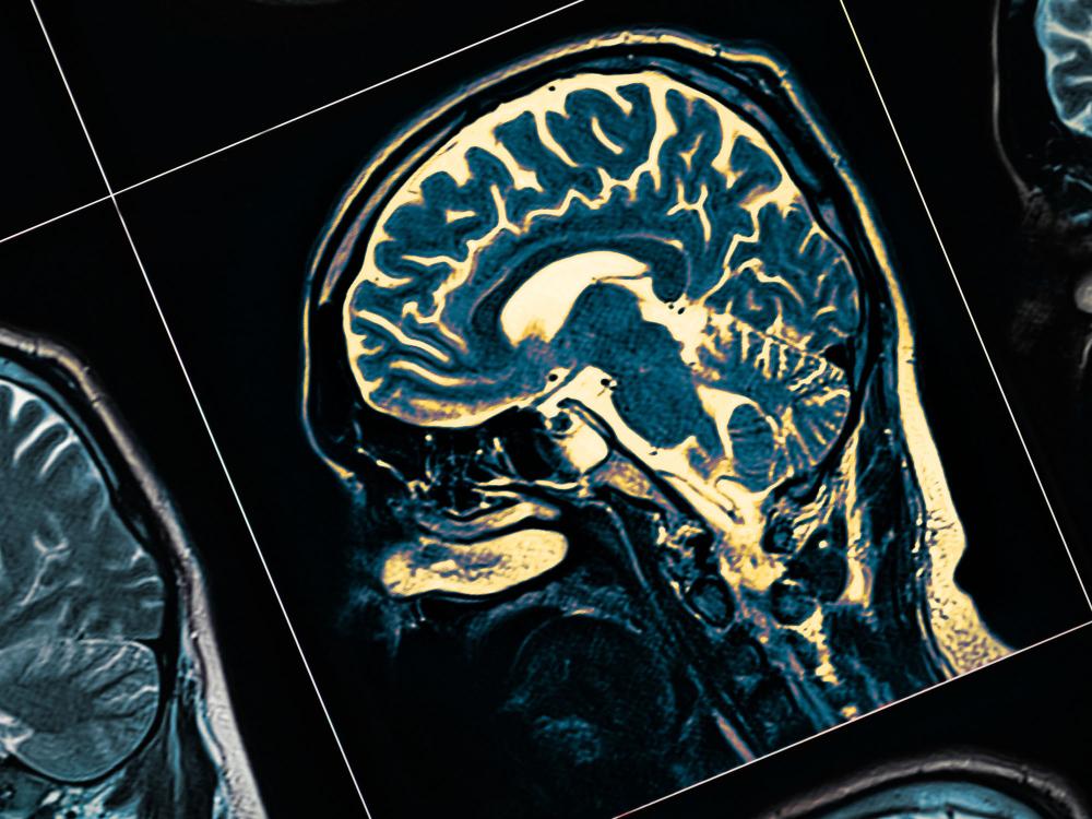 Photo of an MRI scan of the human brain.