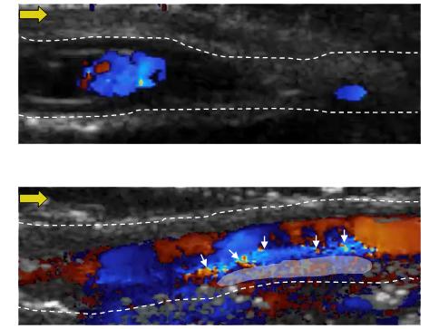 Two stacked ultrasound images. The top is dark with minimal spots of color, while the bottom is colorful with notable points of interest.