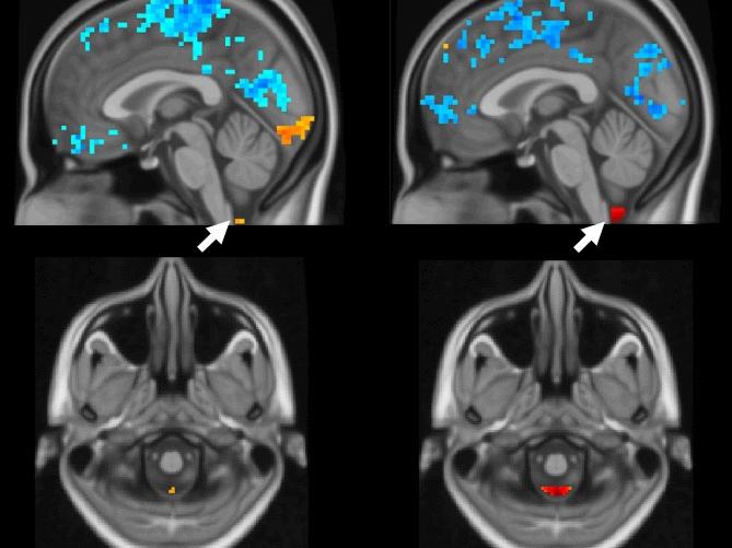 Side-by-side MRI images of a human brain in black and white with blue, orange and red pops of color. 