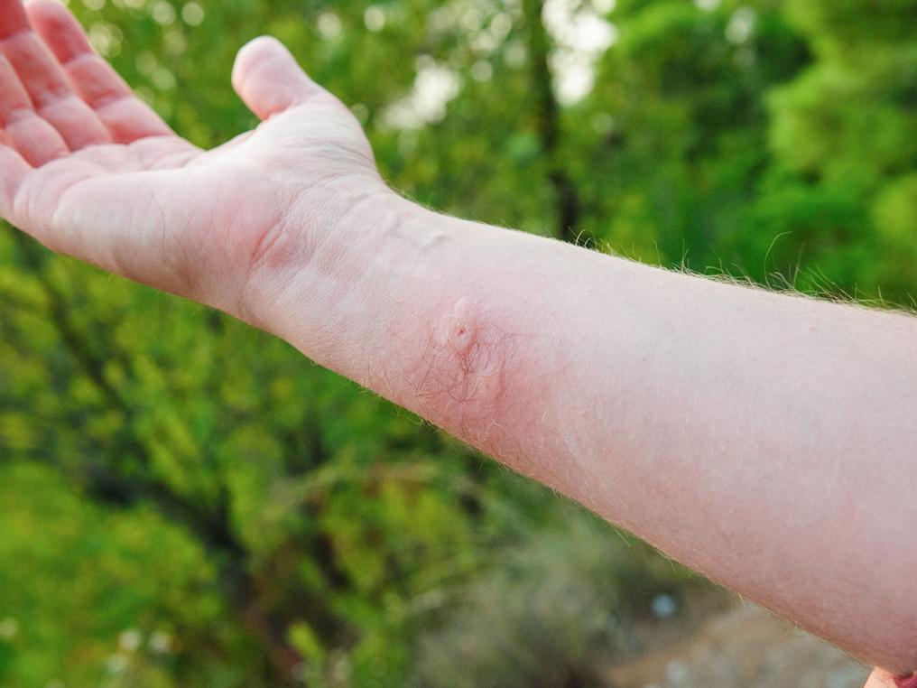 A fore arm with a noticeable bug bite. 