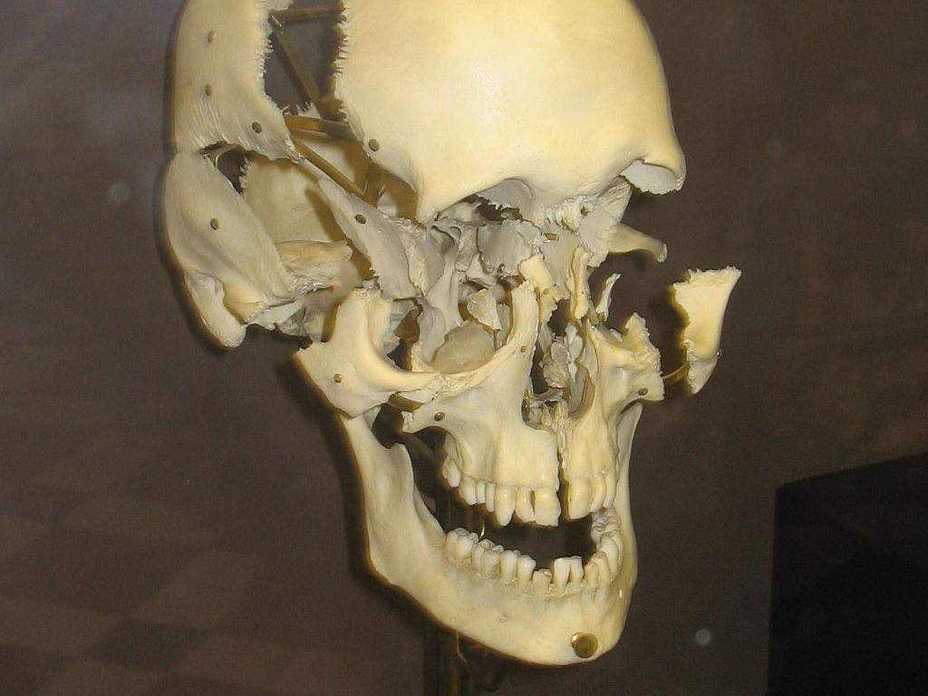 exploded human skull 