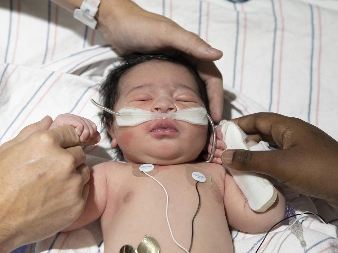 Newborn Aiden Shimp, who has a full head of hair, lies on striped sheets with his eyes closed and his parents’ hands cradling his head and holding each of his hands. He wears a canula in his nose and monitors on his chest.