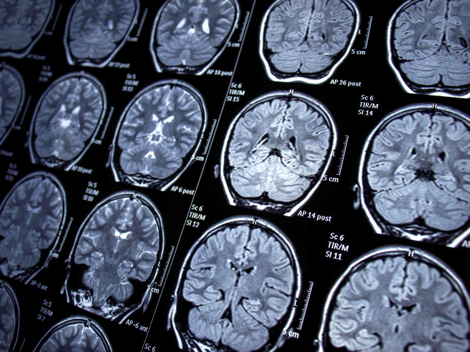 An imaging scan shows several images of a human brain.