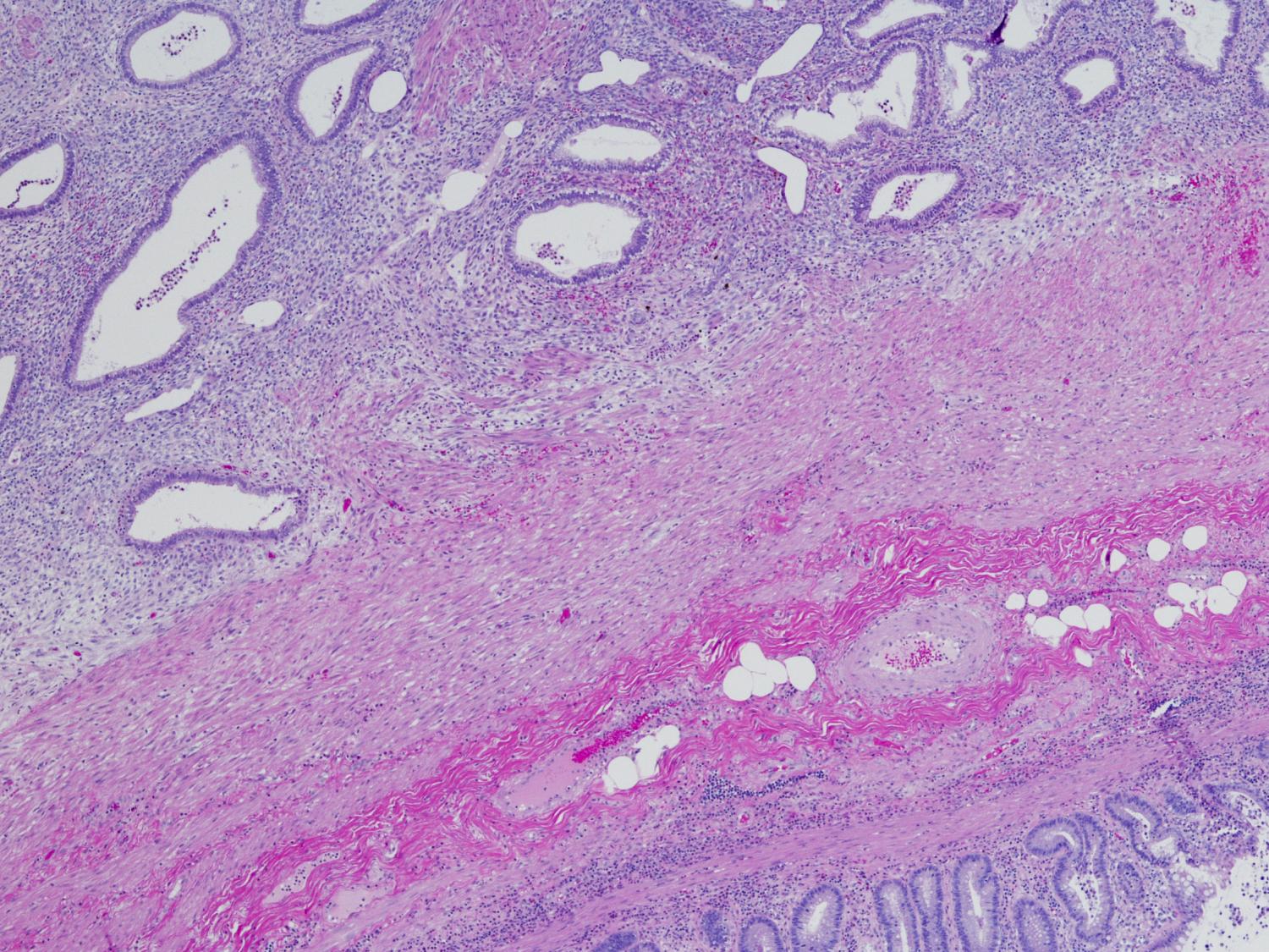 high magnification image of endometriosis in an appendix 