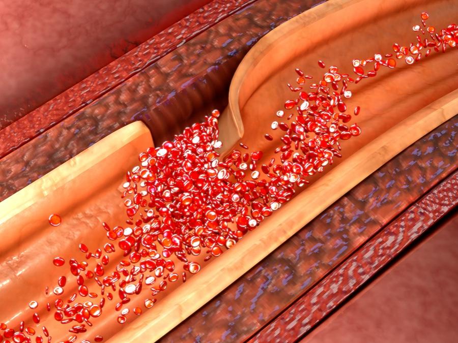 Illustration of an artery dissection.