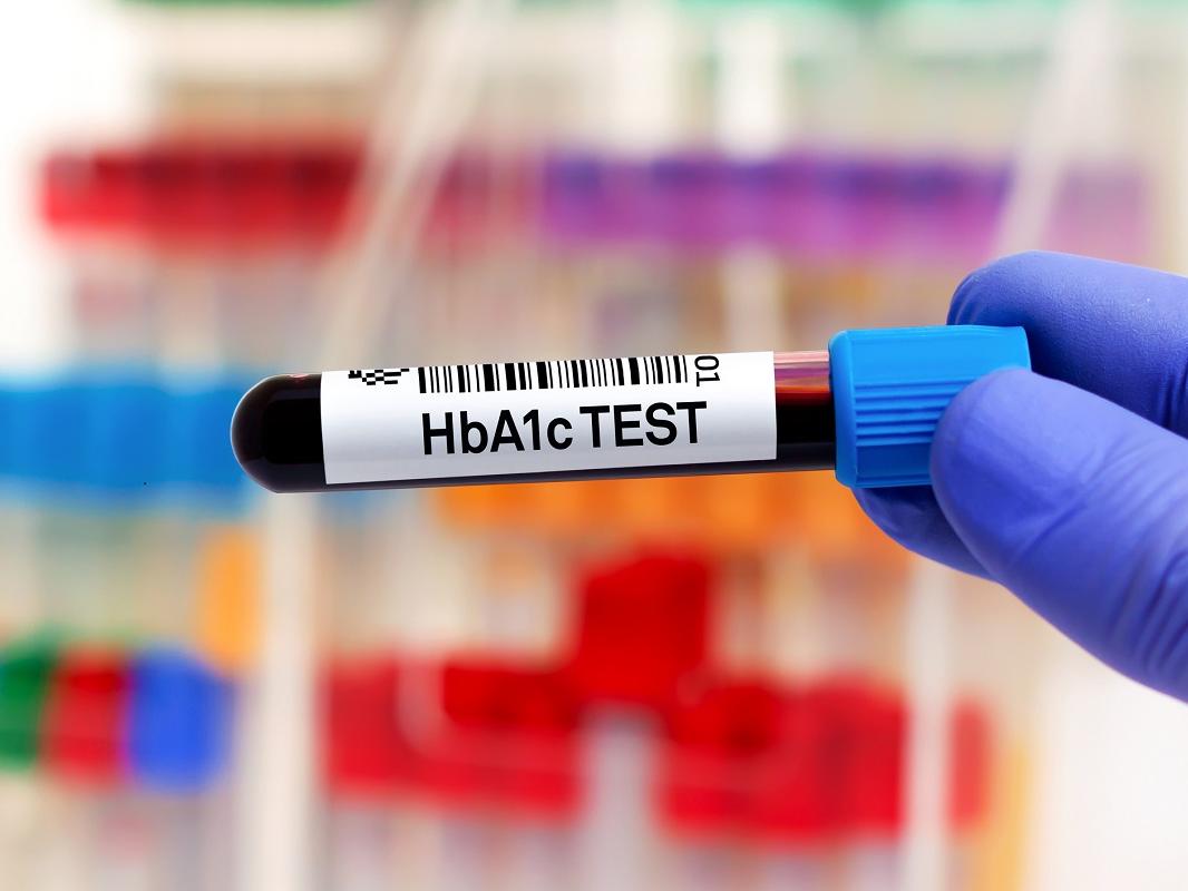 A doctor holds a blood tube for HbA1c analysis and identification of diabetic patient.