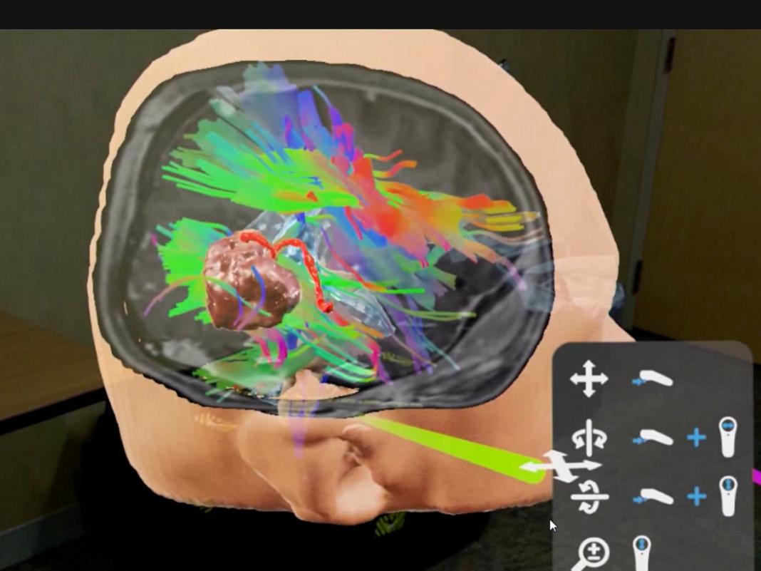 A computer screen view of a human head opened with graphics on the inside around the brain.