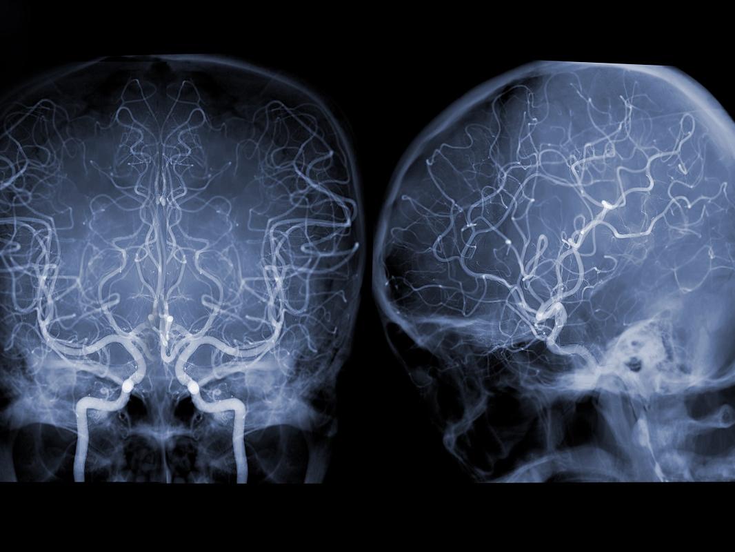 Cerebral angiography image from Fluoroscopy in intervention radiology showing cerebral artery.
