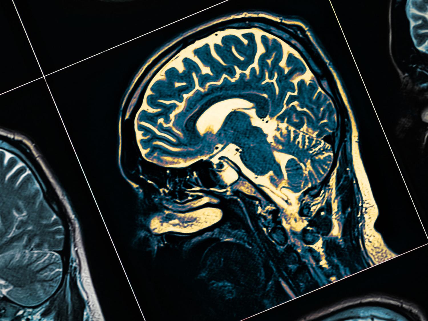 Photo of an MRI scan of the human brain.