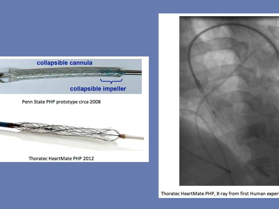 Three images of the percutaneous heart pump