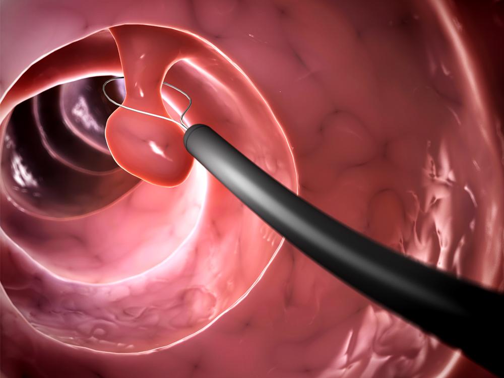 Internal depiction of a polyp being removed from inside of a colon.