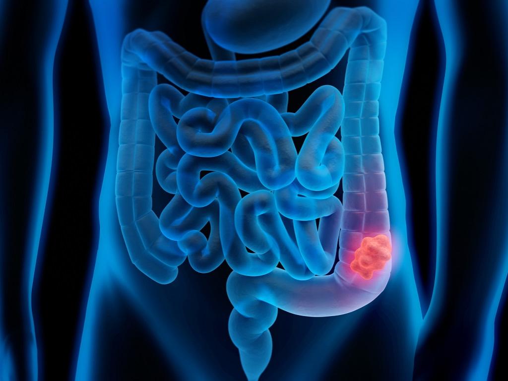 An illustration shows a torso with intestines. A tumor is highlighted.