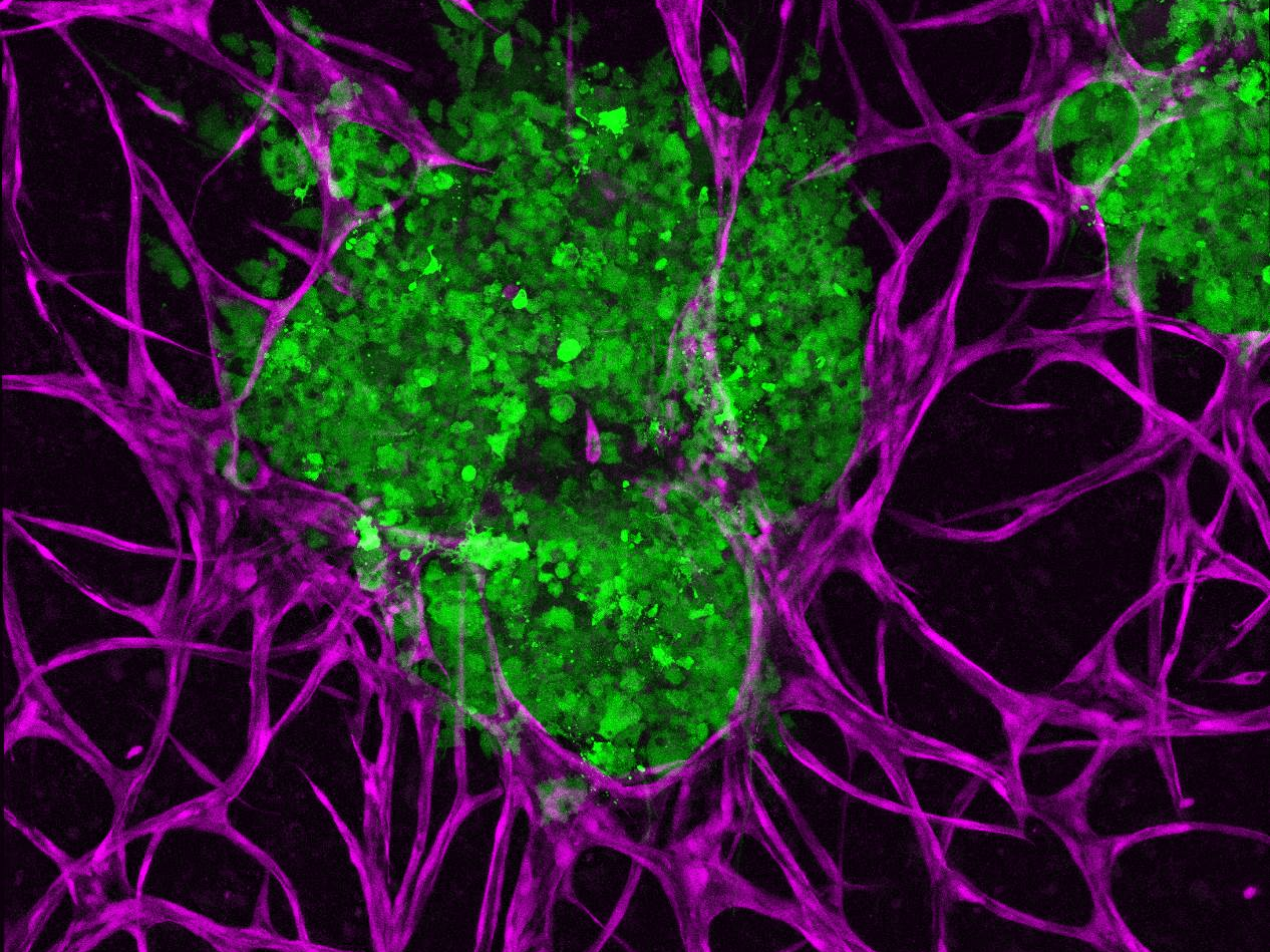 A green tumor is nestled in an interlocking purple branching network. 