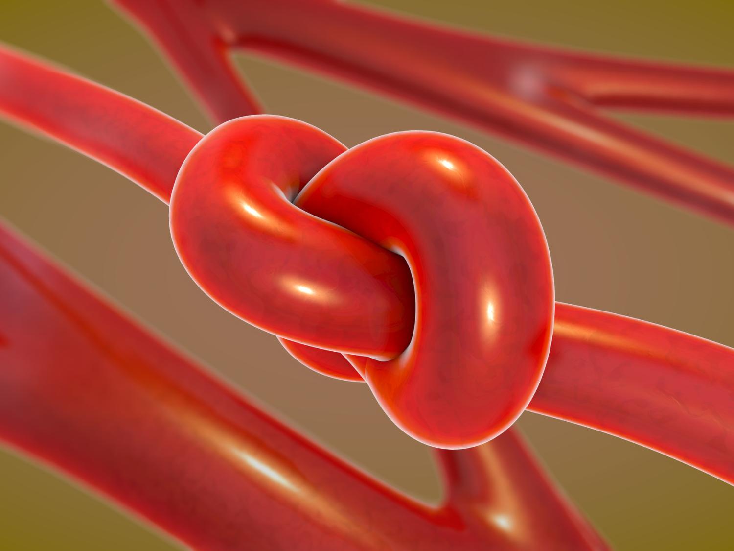 knotted blood vessel