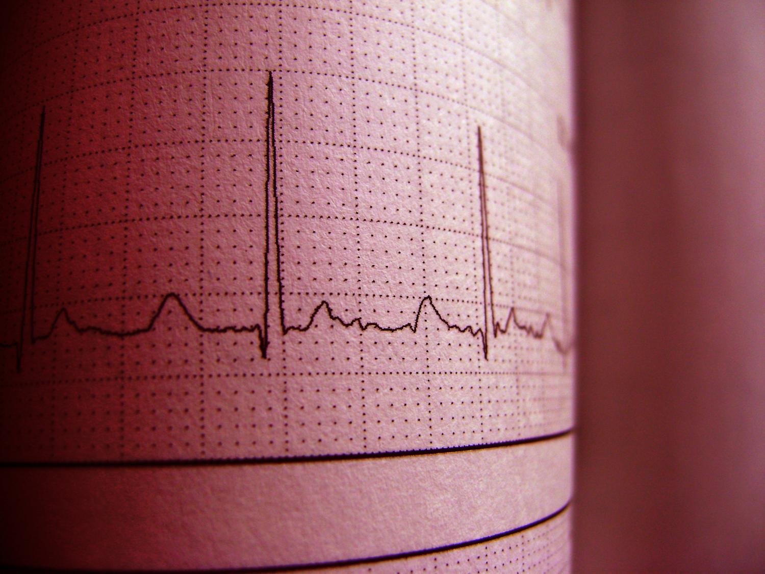 EKG