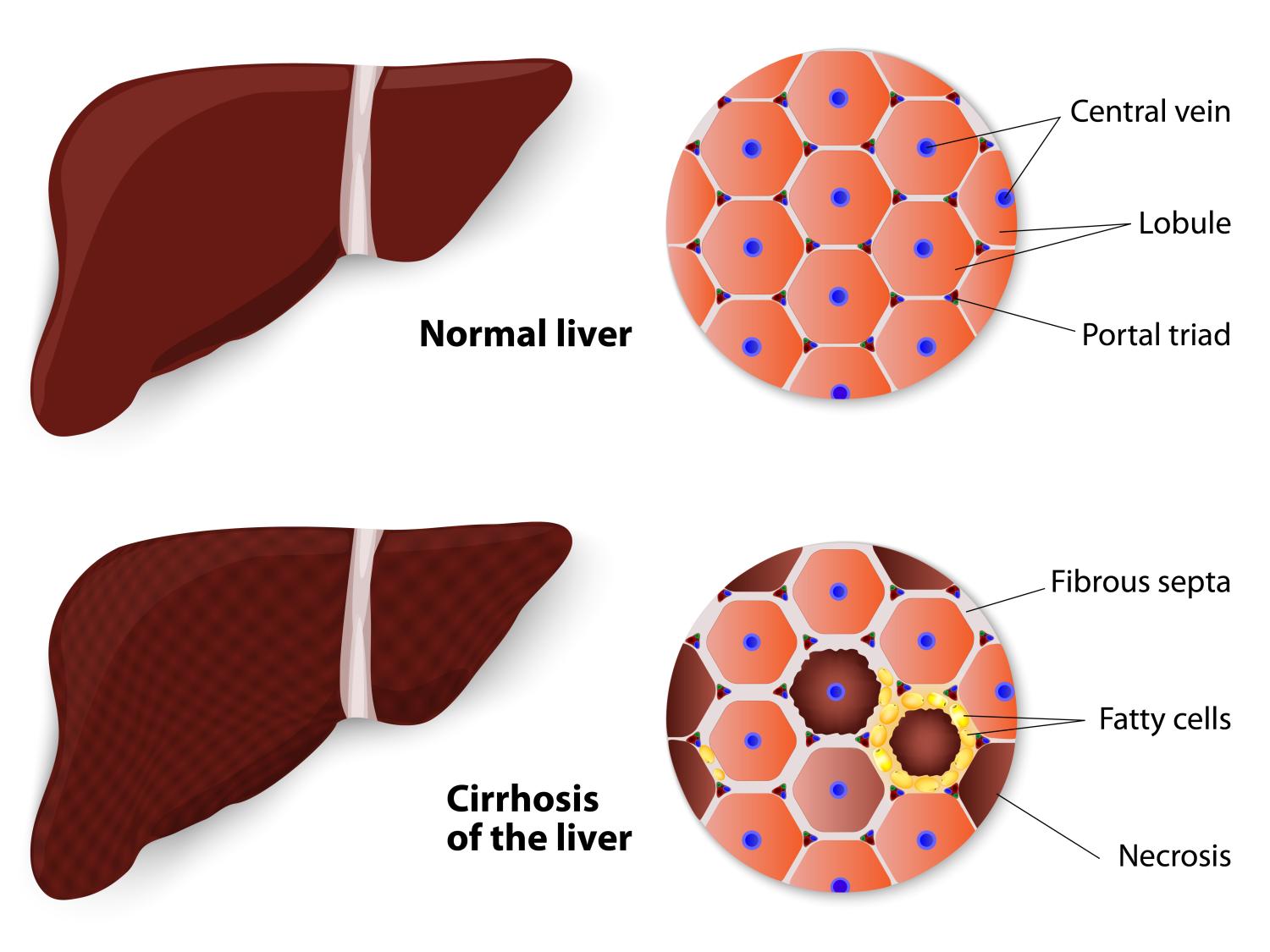 normal and fatty liver illustration