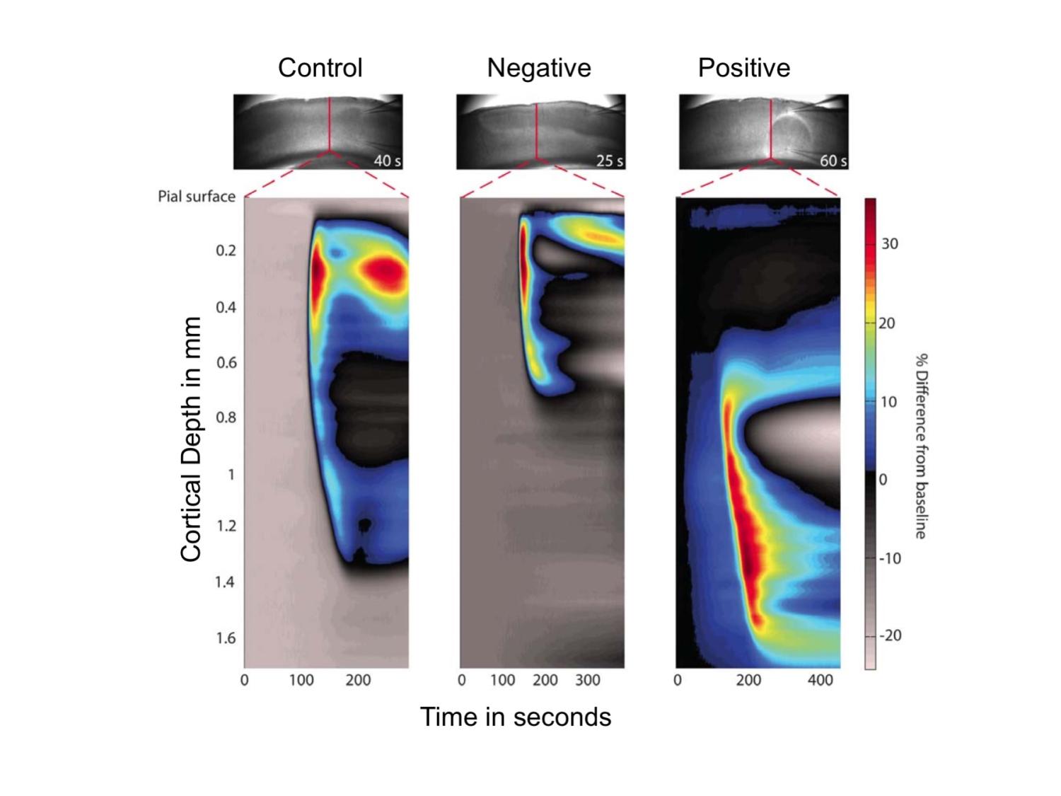 spreading depolarization in brain