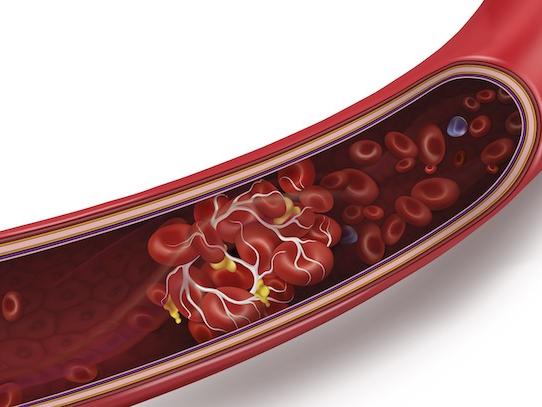 A diagram of a blood clot blocking a vein