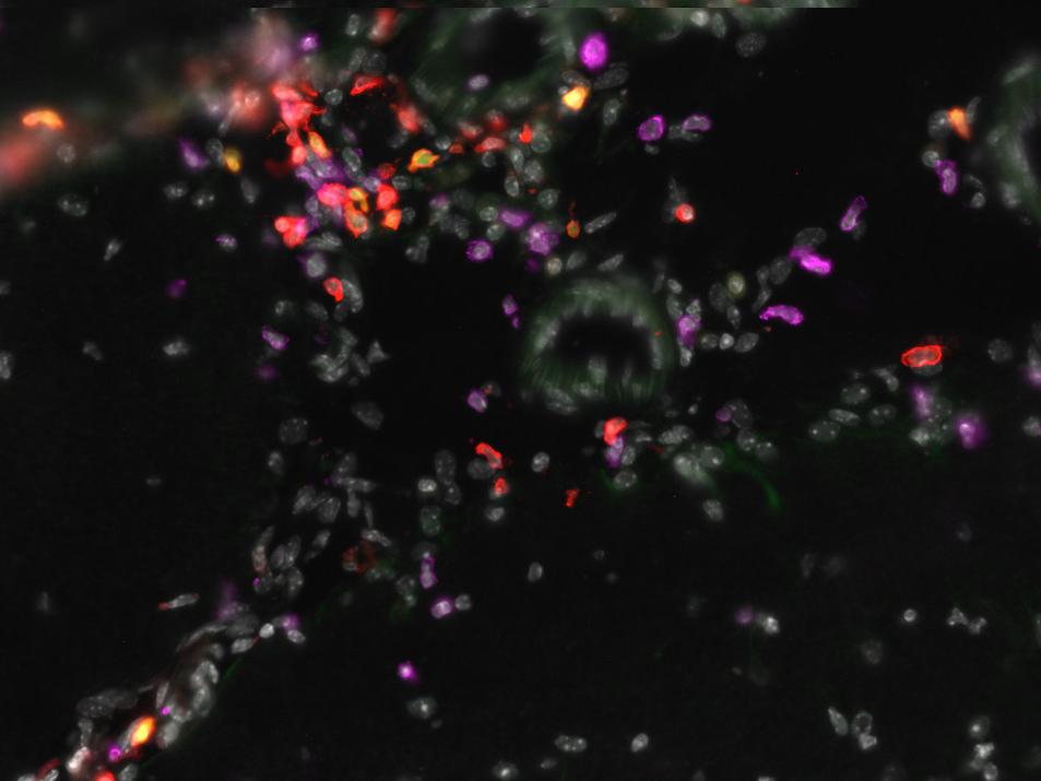 Red, purple and gray cells are present in a sample of a brain of MuPyV-infected mice. The red cells are CD4 T-cells and the purple cells are CD8 tissue-resident-memory cells. 