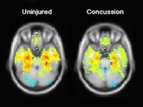 MRI concussion scan image