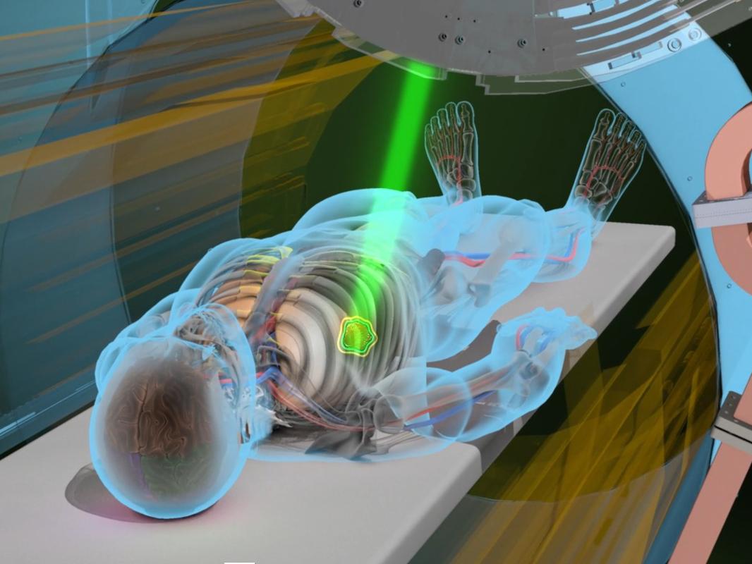 An animated image depicts a patient lying down and being treated with a beam of radiation from the MRIdian Radiation Therapy System.